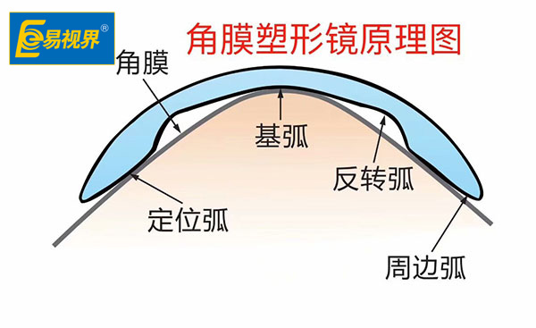 近視以后可否呆角膜塑形鏡【易視界眼健康管理機構(gòu)】