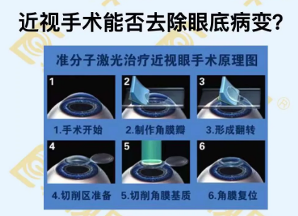 近視手術(shù)能否去除眼底病變？