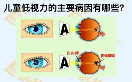 兒童低視力主要病因有哪些？