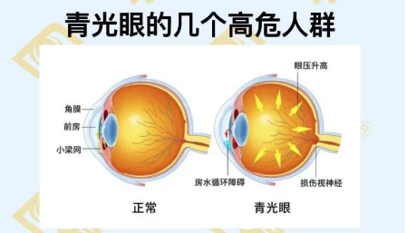 青光眼的幾個(gè)高危人群？