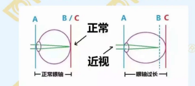 哪個年齡近視度數(shù)最容易增長？