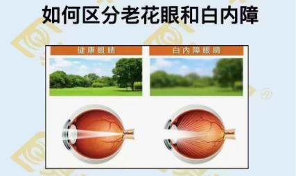 如何區(qū)分老花眼和白內(nèi)障？
