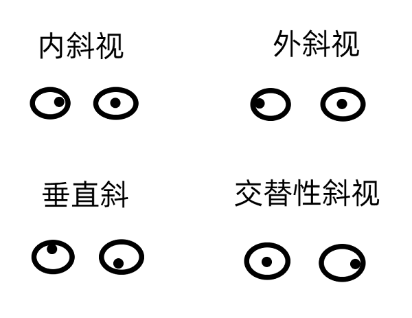 斜視早期的癥狀有哪些？
